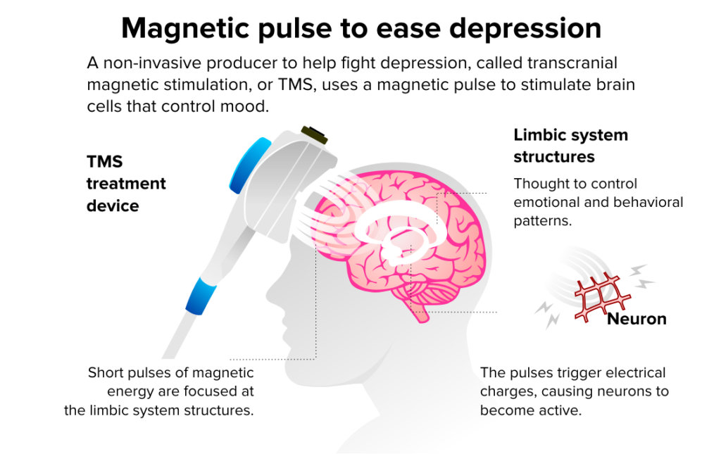 TMS Therapy